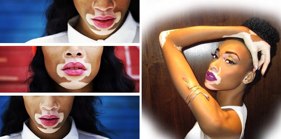 Mulheres com vitiligo mostram sua beleza real